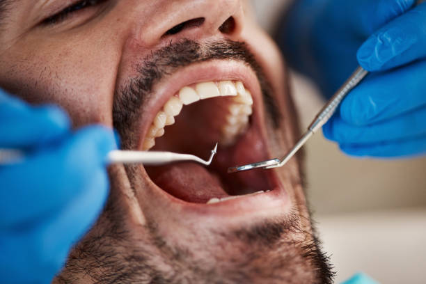 Best Emergency Wisdom Teeth Removal in Olympia, WA